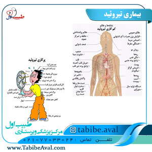 بیماری تیروئید و علائم آن   طبیب اول
