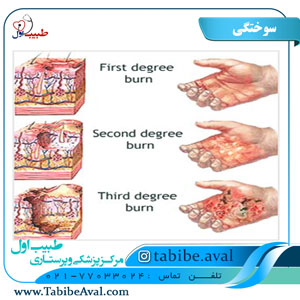 درمان سوختگی | طبیب اول