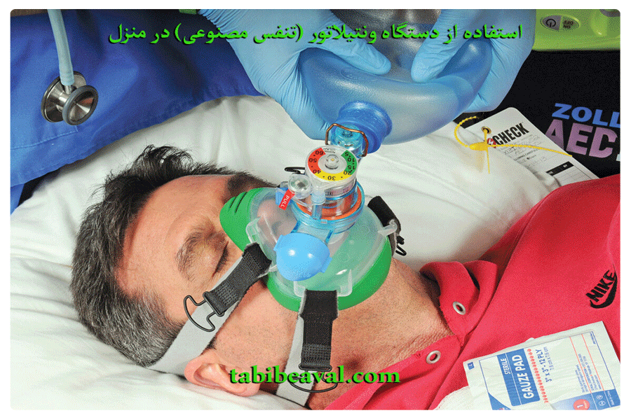 دستگاه ونتیلاتور (تنفس مصنوعی) در منزل