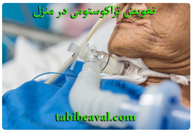 تعویض تراکوستومی درمنزل