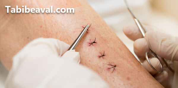 بخیه بریدگی در منزل شرق تهران - طبیب اول