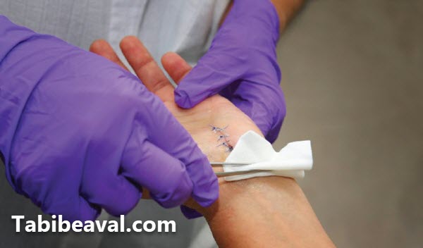 بخیه بریدگی در منزل شرق تهران - طبیب اول