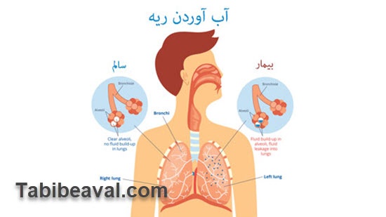تخلیه مایع دور ریه در منزل | طبیب اول