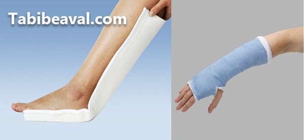 گچ گیری و آتل گیری در منزل - طبیب اول