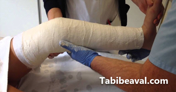 گچ گیری و آتل گیری در منزل - طبیب اول