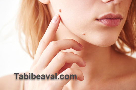 در آوردن خال و ضایعات پوستی در منزل | طبیب اول