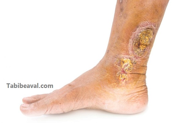 معالجه زخمهای حاد در منزل | طبیب اول