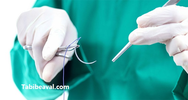 بخیه زخمهای حاد در منزل | طبیب اول