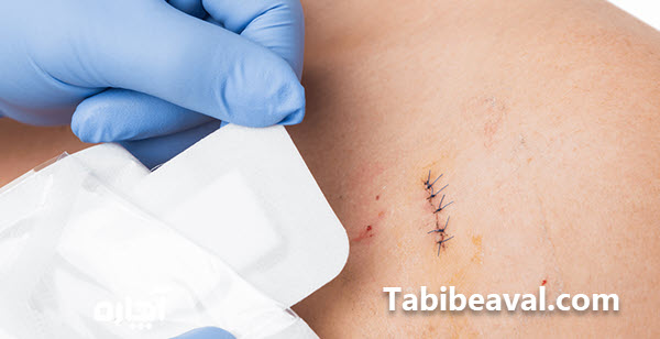 بخیه کردن زخم توسط پرستار در منزل - طبیب اول