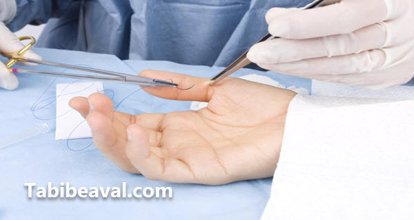 بخیه کردن زخم توسط پرستار در منزل - طبیب اول