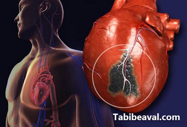 چگونه سکته قلبی را تشخیص دهیم ؟ - طبیب اول