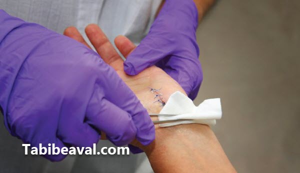 بخیه کردن زخم توسط پرستار در منزل   طبیب اول