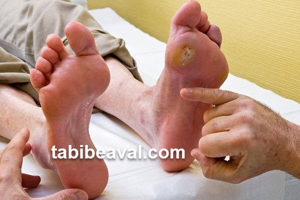 پانسمان زخم پای دیابتی در منزل | طبیب اول