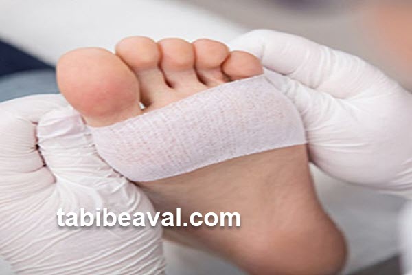 پانسمان زخم پای دیابتی در منزل | طبیب اول