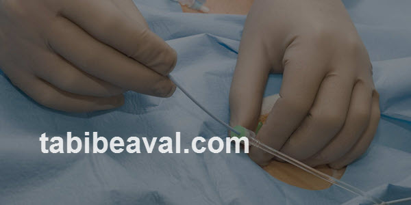 قیمت دقیق خدمات سوندگذاری | طبیب اول