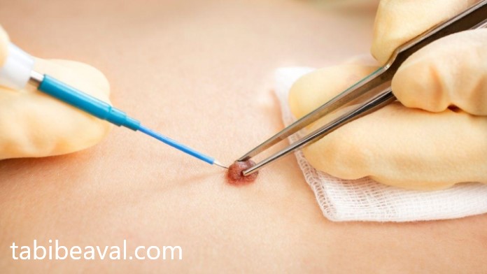 خدمات بخیه بریدگی ها در منزل شخصی با پزشک متخصص در تهران | طبیب اول 