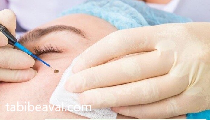 بخیه بریدگی و درآوردن خال یا ضایعات پوستی در منزل | طبیب اول