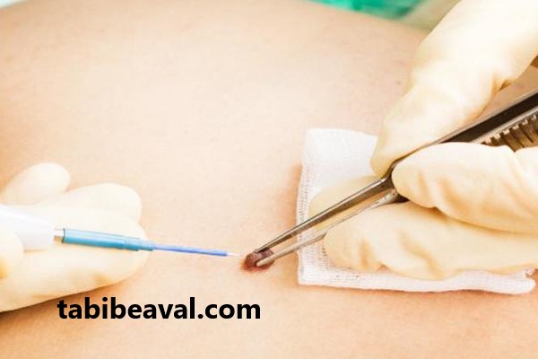 بهترین مرکز برای برداشتن خال | طبیب اول