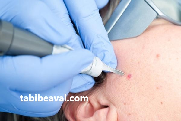 مزایای برداشتن خال | طبیب اول