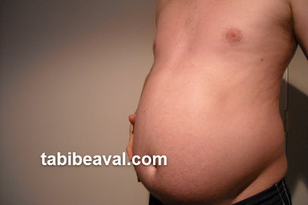 بررسی پاراسنتز (مایع کشی شکم) | طبیب اول