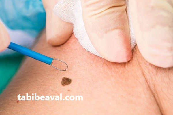 بهترین پزشک خال برداری در منزل | طبیب اول