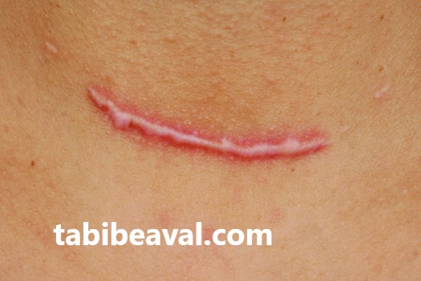 بررسی انواع مختلف زخم و درمان آن | طبیب اول